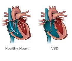نقص دیواره بین بطنی - VSD