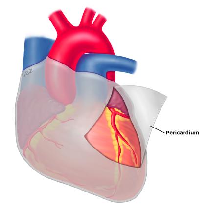 تامپوناد -tamponade